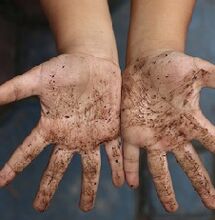 Dirty hands as a cause of worms in a child