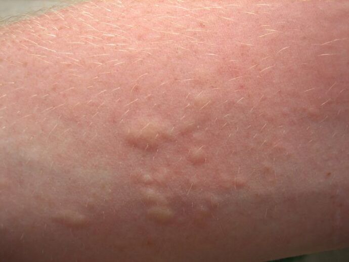 an itchy allergic skin rash may be a symptom of ascariasis