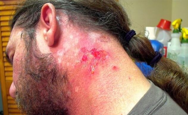 A wound that bleeds on the neck with the Morgellons virus