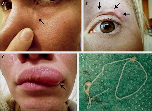 The main manifestations of heartworm disease on the face
