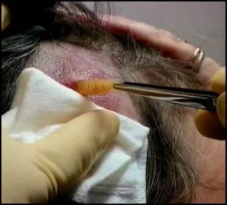 Removal of parasite larvae under the skin