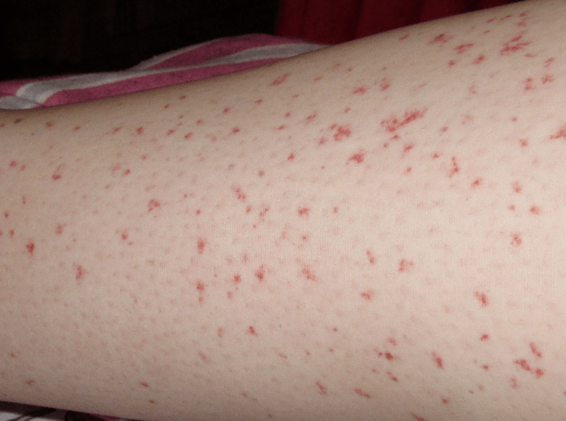 A rash on the skin is a sign of an acute stage of worm infection