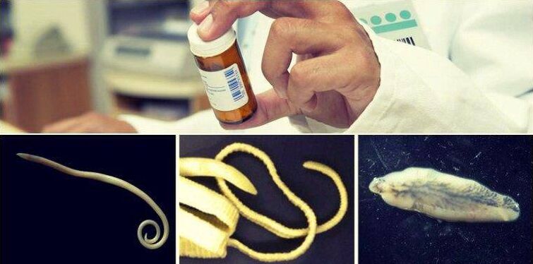 Types of worms and medical way to get rid of them